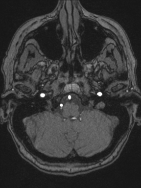 Cerebral arteriovenous malformation with hemorrhage (Radiopaedia 34422-35737 Axial MRA 12).png