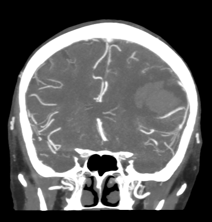 Cerebral arteriovenous malformation with lobar hemorrhage (Radiopaedia 44725-48511 B 21).png