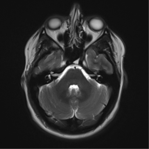 File:Cerebral cavernoma and development venous anomaly (Radiopaedia 37603-39482 Axial T2 6).png