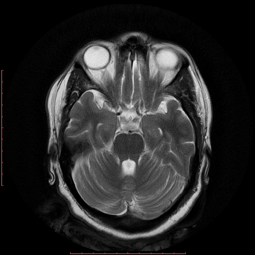 File:Cerebral cavernous malformation (Radiopaedia 26177-26306 Axial T2 8).jpg
