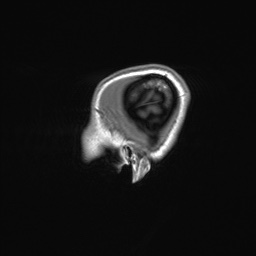 File:Cerebral cavernous venous malformation (Radiopaedia 70008-80021 Sagittal T1 3).jpg