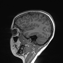 File:Cerebral cavernous venous malformation (Radiopaedia 70008-80021 Sagittal T1 57).jpg