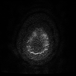 File:Cerebral cavernous venous malformation (Zabramski type II) (Radiopaedia 85511-101198 Axial DWI 65).jpg