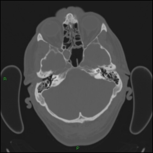 Cerebral contusions (Radiopaedia 33868-35039 Axial bone window 42).jpg
