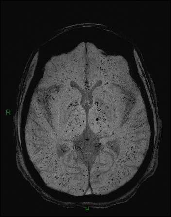Cerebral fat embolism (Radiopaedia 35022-36525 Axial SWI 16).jpg