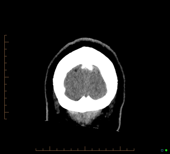Cerebral fat embolism (Radiopaedia 85521-101224 Coronal non-contrast 60).jpg
