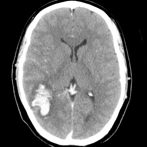 Cerebral hemorrhage secondary to arteriovenous malformation (Radiopaedia 33497-34561 B 28).png