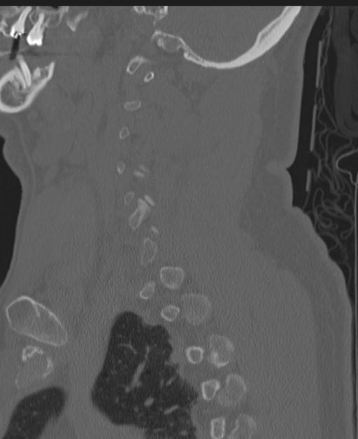 Cerebral hemorrhagic contusions and cervical spine fractures (Radiopaedia 32865-33841 Sagittal bone window 71).jpg