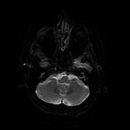 Cerebral metastases - melanoma (Radiopaedia 80972-94522 Axial DWI 72).jpg