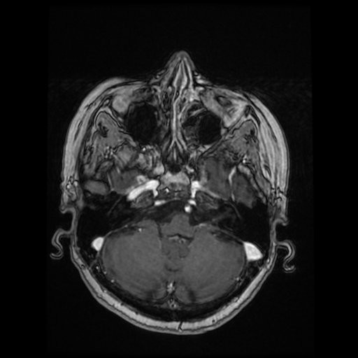 Cerebral metastases - melanoma (Radiopaedia 80972-94522 Axial T1 C+ 35).jpg