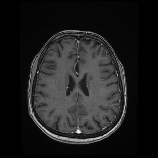 Cerebral metastases - melanoma (Radiopaedia 80972-94522 Axial T1 C+ 64).jpg