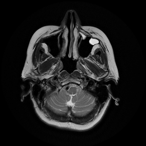 File:Cerebral metastases - melanoma (Radiopaedia 80972-94522 Axial T2 5).jpg
