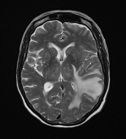 File:Cerebral metastasis (Radiopaedia 46744-51248 Axial T2 14).png