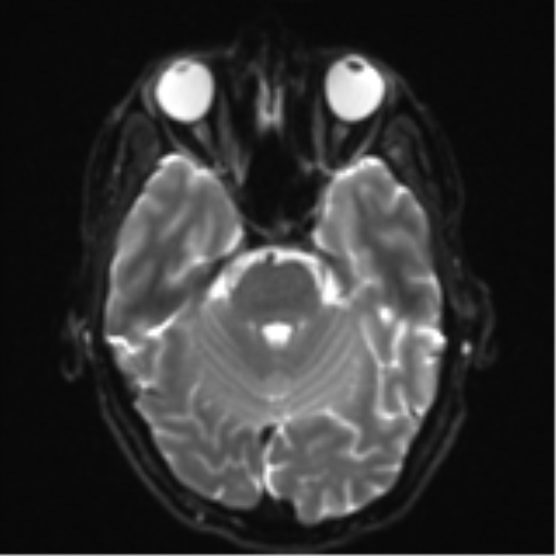 Cerebral metastasis - melanoma (Radiopaedia 54718-60954 Axial DWI 10).png