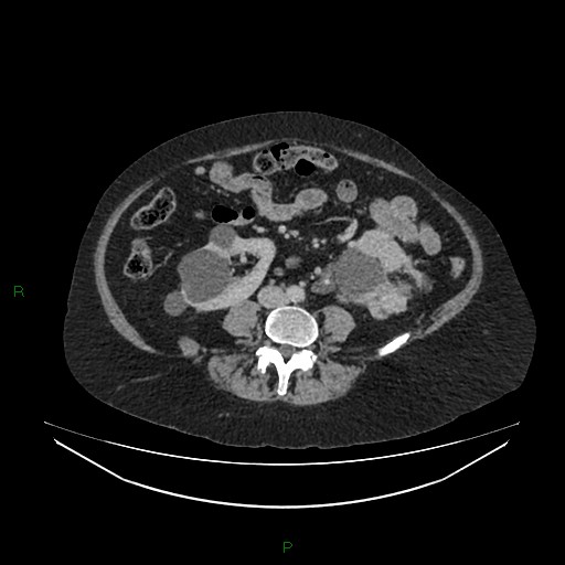 File:Cerebral metastasis from renal cell carcinoma (Radiopaedia 82306-96378 A 106).jpg