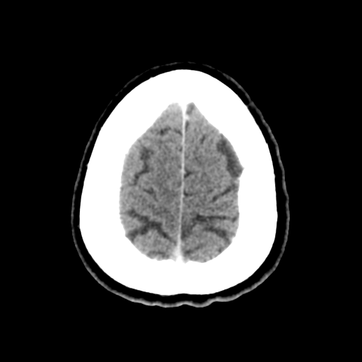Cerebral metastasis to basal ganglia (Radiopaedia 81568-95412 Axial C+ delayed 50).png