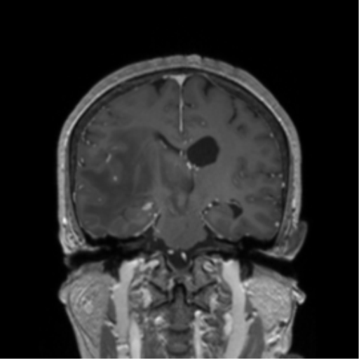 File:Cerebral metastasis to basal ganglia (Radiopaedia 81568-95413 Coronal T1 C+ 22).png