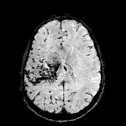 Cerebral parenchymal arteriovenous malformation (Radiopaedia 27280-27456 Axial SWI 74).jpg