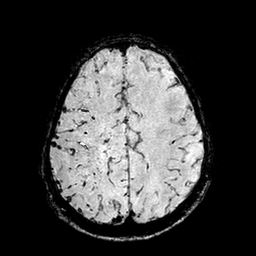Cerebral parenchymal arteriovenous malformation (Radiopaedia 27280-27456 Axial SWI 89).jpg