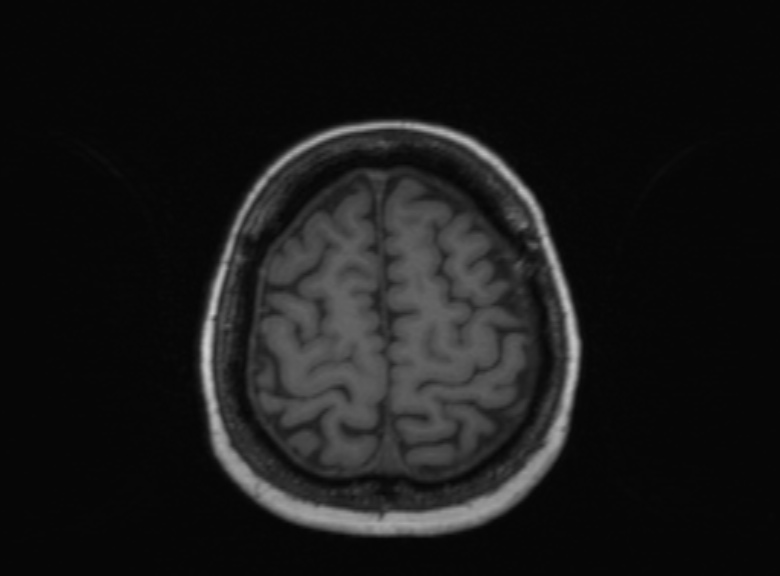 Cerebral ring enhancing lesions - cerebral metastases (Radiopaedia 44922-48817 Axial T1 133).jpg