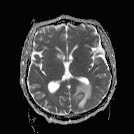 File:Cerebral toxoplasmosis (Radiopaedia 43956-47461 Axial ADC 10).jpg