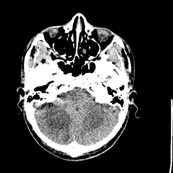 Cerebral toxoplasmosis (Radiopaedia 53993-60131 Axial non-contrast 19).jpg