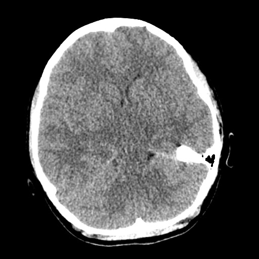 Cerebral tuberculosis with dural sinus invasion (Radiopaedia 60353-68018 Axial non-contrast 21).jpg