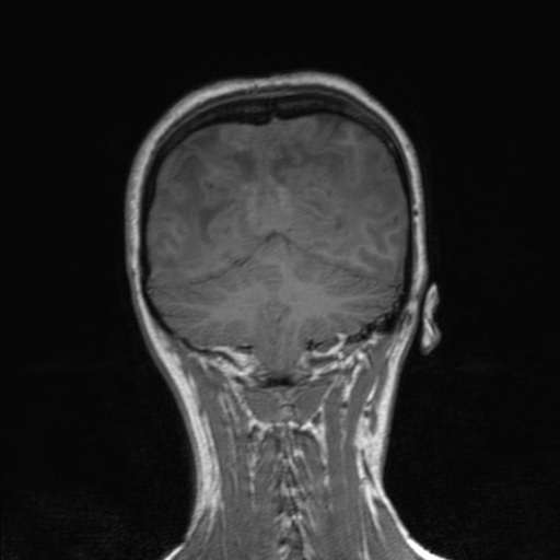 Cerebral tuberculosis with dural sinus invasion (Radiopaedia 60353-68090 Coronal T1 142).jpg