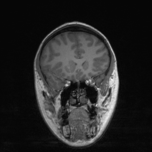 Cerebral tuberculosis with dural sinus invasion (Radiopaedia 60353-68090 Coronal T1 63).jpg