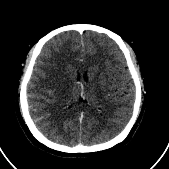 Cerebral venous hemorrhagic infarct from venous sinus thrombosis (Radiopaedia 55433-61883 Axial C+ delayed 68).jpg