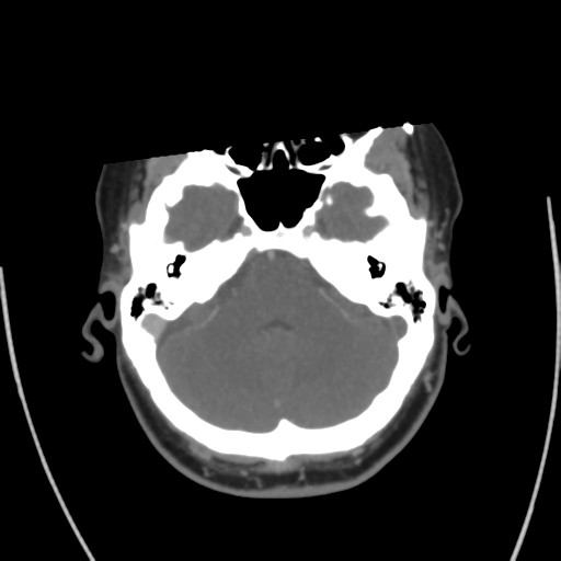 Cerebral venous infarct related to dural venous sinus thromboses (Radiopaedia 35292-36804 Axial C+ delayed 13).png