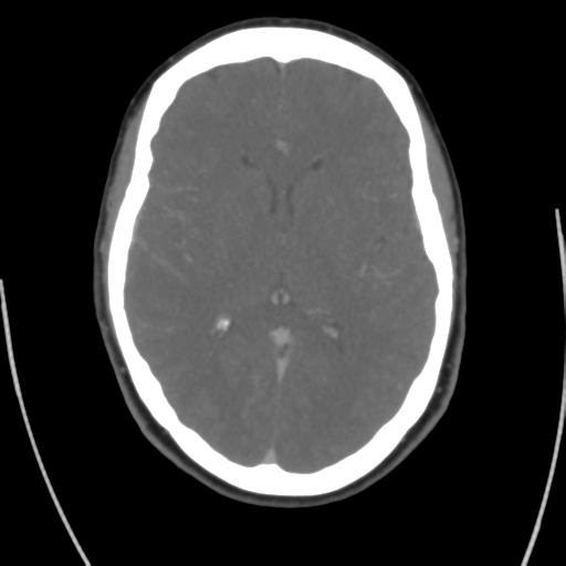 Cerebral venous infarct related to dural venous sinus thromboses (Radiopaedia 35292-36804 Axial C+ delayed 26).png