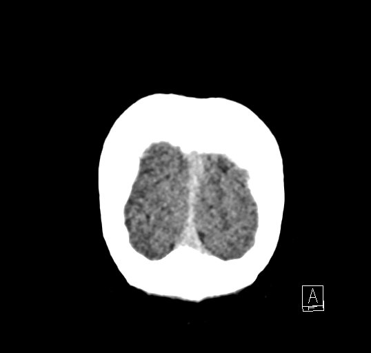 Cerebral venous infarction with hemorrhage (Radiopaedia 65343-74381 Coronal non-contrast 54).jpg