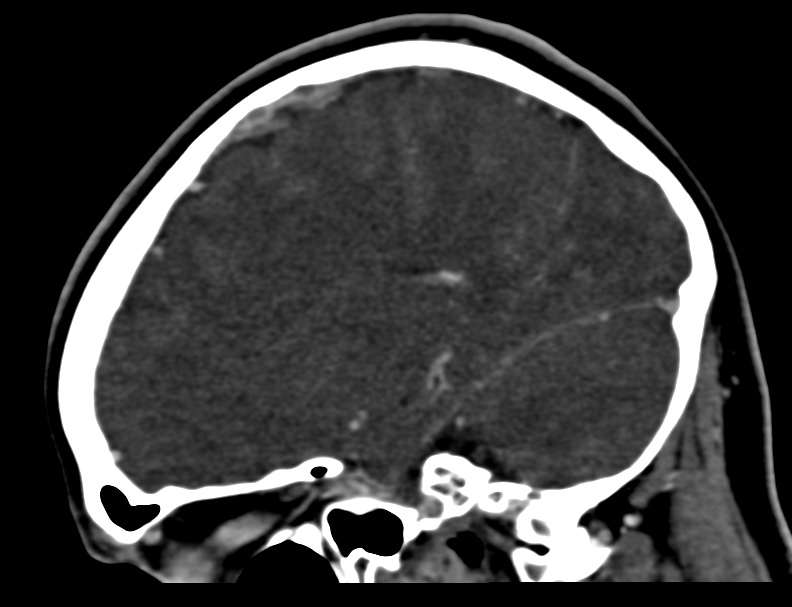 Cerebral venous sinus thrombosis (Radiopaedia 59224-66646 Sagittal C+ delayed 12).jpg