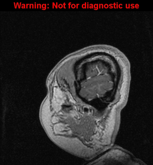 File:Cerebral venous thrombosis (Radiopaedia 37224-39208 Sagittal T1 C+ 14).jpg