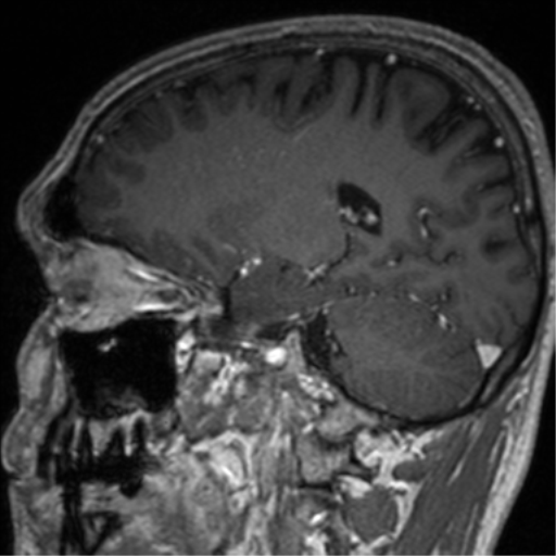 Cerebral venous thrombosis (Radiopaedia 38392-40469 Sagittal T1 C+ 35).png