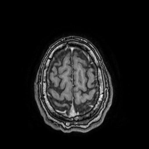 File:Cerebral venous thrombosis with secondary intracranial hypertension (Radiopaedia 89842-106957 Axial T1 C+ 147).jpg