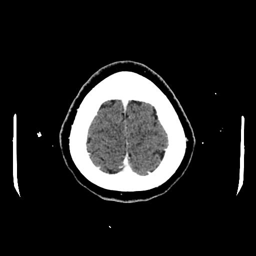 Cerebral venous thrombosis with venous hemorrhagic infarct (Radiopaedia 90354-107660 Axial with contrast 151).jpg