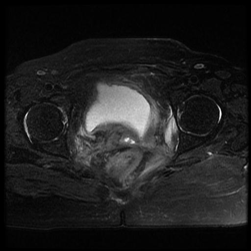 File:Cervical carcinoma (Radiopaedia 70924-81132 Axial T2 fat sat 11).jpg