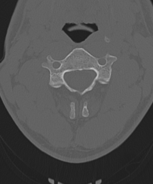 Cervical intercalary bone (Radiopaedia 35211-36748 Axial bone window 25).png