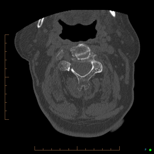 Cervical spine fracture - ankylosing spondylitis (Radiopaedia 76835-88706 Axial bone window 74).jpg