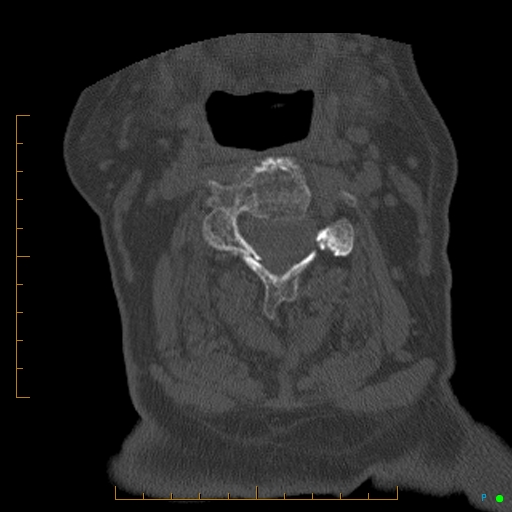 Cervical spine fracture - ankylosing spondylitis (Radiopaedia 76835-88706 Axial bone window 90).jpg