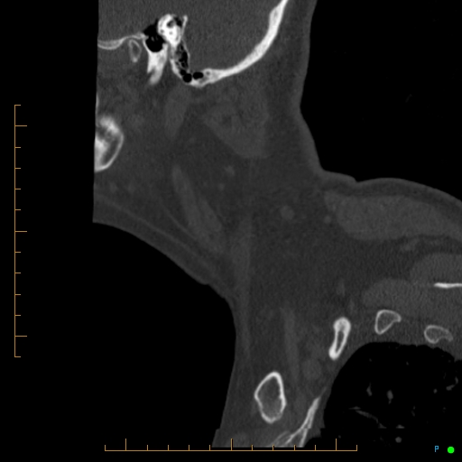 Cervical spine fracture - ankylosing spondylitis (Radiopaedia 76835-88706 Sagittal bone window 108).jpg