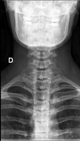 File:Cervical spine posterior ligamentous complex rupture (Radiopaedia 63486-72100 Frontal 1).jpg