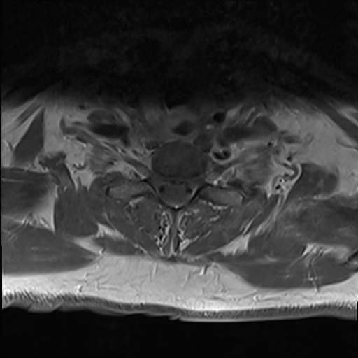 File:Cervical tumor-like myelopathy due to Type V dAVF (Radiopaedia 82461-96604 Axial T1 C+ fat sat 31).jpg