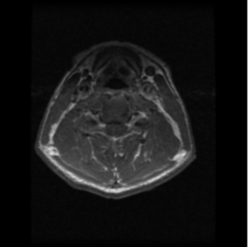 File:Cervical vertebrae metastasis (Radiopaedia 78814-91667 Axial T1 C+ 11).png