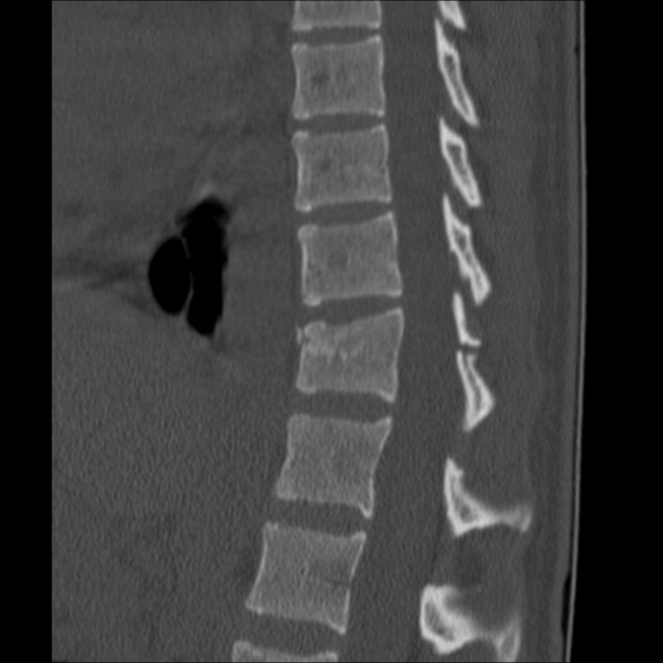 Chance fracture (Radiopaedia 36521-38081 Sagittal bone window 37).jpg