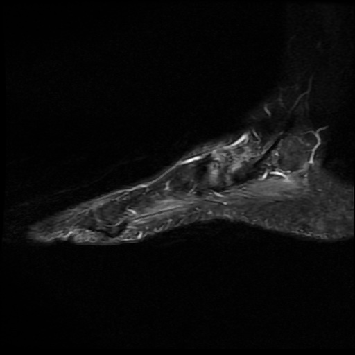 File:Charcot arthropathy (Radiopaedia 55056-61422 Sagittal T2 fat sat 3).jpg