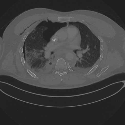 Chest multitrauma - aortic injury (Radiopaedia 34708-36147 Axial bone window 145).png