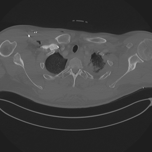 File:Chest multitrauma - aortic injury (Radiopaedia 34708-36147 Axial bone window 39).png